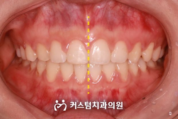 앞니 치간이개 부분교정 후 구강 사진