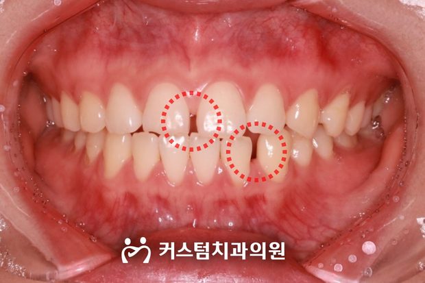 앞니 치간이개 부분교정 전 구강 사진