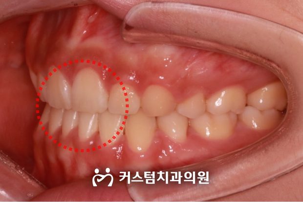 돌출입 치간이개 전체교정 후 구강 사진