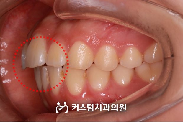 돌출입 치간이개 전체교정 전 구강 사진