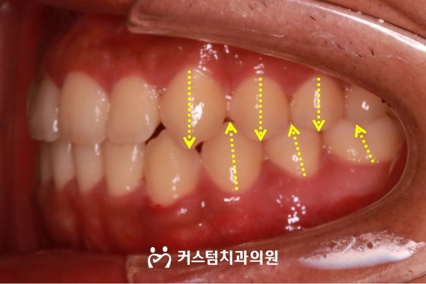 골격성 주걱턱 양악수술 후 구강 사진