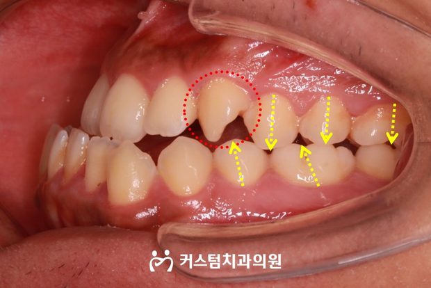 골격성 주걱턱 양악수술 전 구강 사진