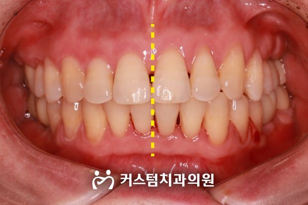 어금니 상실 앞니 벌어짐 부분교정 임플란트 후 구강 사진