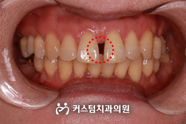 어금니 상실 앞니 벌어짐 부분교정 임플란트 전 구강 사진