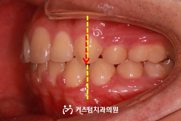 하악 매복치 교정 외과적 견인 후 구강 사진