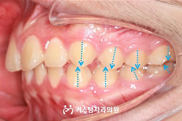 하악 매복치 교정 외과적 견인 전 구강 사진