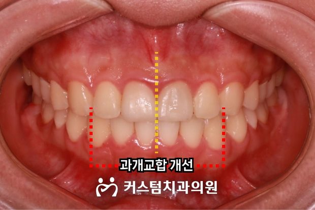 전치부 과개교합 비발치 전체교정 후 구강 사진