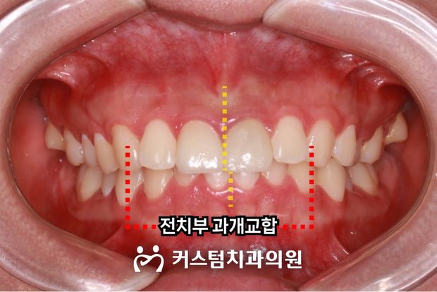 전치부 과개교합 비발치 전체교정 전 구강 사진